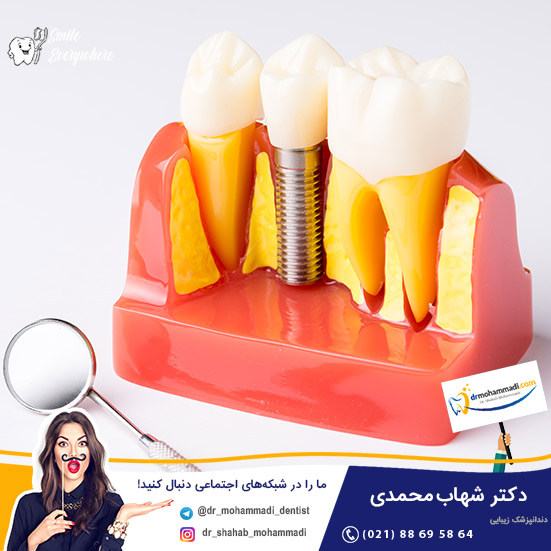 همه چیز درباره کاشت دندان، مراحل، عوارض و هزینه آن - کلینیک دندانپزشکی دکتر شهاب محمدی